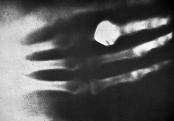 First ever human X-ray
